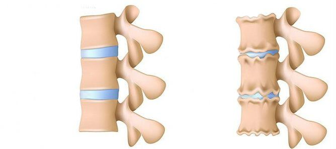 Osteochondrosis from within