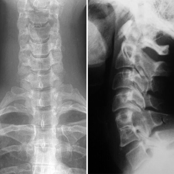 X -Cervical spine and