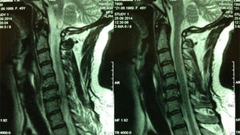 Magnetic Resonance of the Cervical Department
