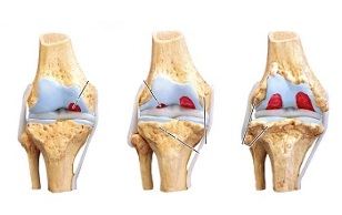 stages of knee joint arthrosis