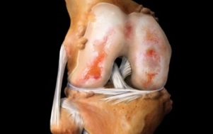 what is arthrosis of the knee joint