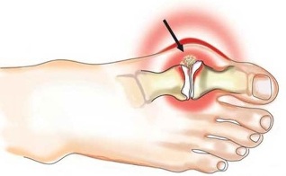 Inflammation of the joint between thumb and foot in arthritis