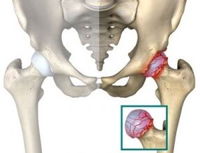 causes of hip joint atrosis