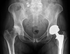 diagnosis of arthrosis of the hip joint
