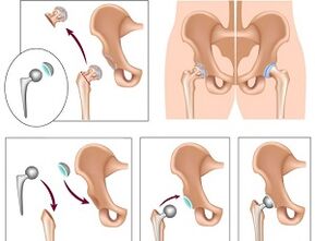 endoprosthesis for arthrosis of the hip joint