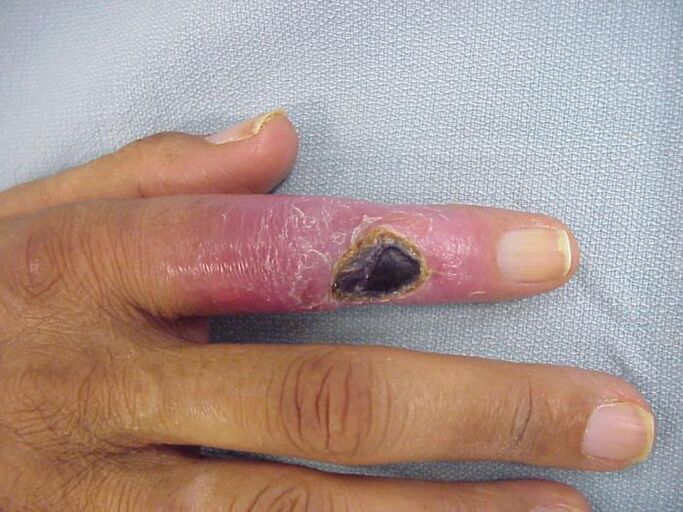 osteomyelitis as a cause of pain in finger joints