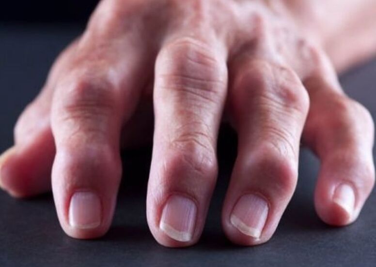 rheumatoid arthritis as a cause of pain in finger joints