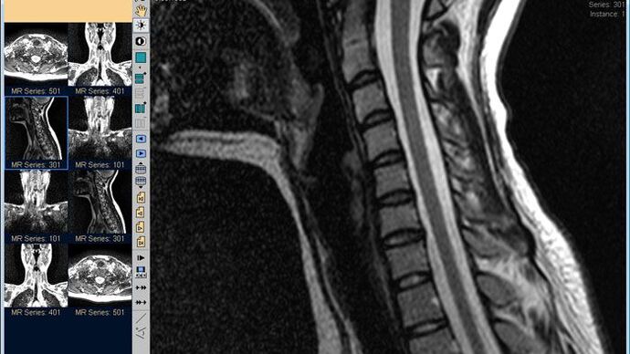 Cervical spine MRI is the best method for diagnosing neck pain
