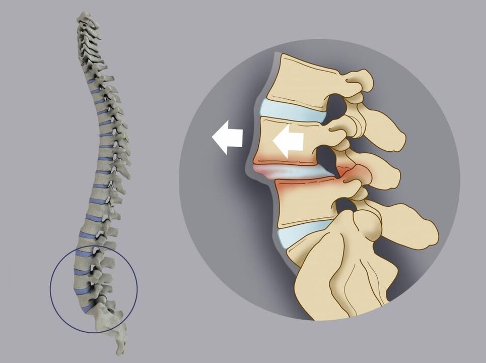 displacement of vertebrae as a cause of back pain